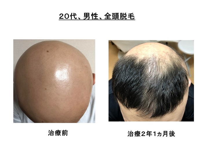 円形脱毛症　病院